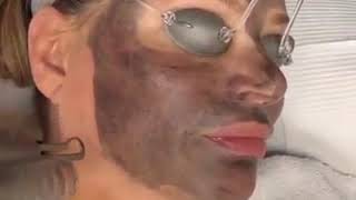 Carbon Laser Peel at AMA Med Spa