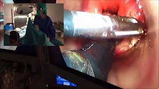 TAMIS & Endoscopic Ultrasound in the Resolution of a Para-rectal Tumour