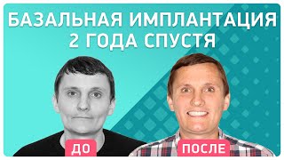 Отзыв год спустя ? об имплантации за 3 дня от реального пациента Smile-at-Once