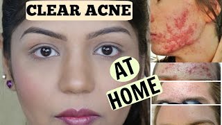 How To Cure Acne Fast & Overnight & Skin Lightening Face Mask | SuperPrincessjo