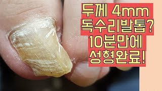 [핵소름]?발톱두께 4mm?비대증 발톱 성형완료!