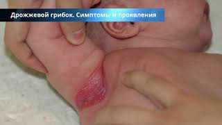 Дрожжевой грибок у женщин и мужчин - лечение, причины, симптомы, народные средства, фото с описанием