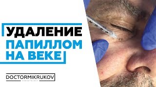 Удаление папиллом на веке Ростов-на-Дону #удалениепапиллом #удалениеродинок