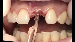 ANKYLOS implant (2.1) / Имплантация системой Ankylos (2.1)