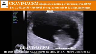 GRAVIMAGEM 21506 Ultrassom morfológico em gravidez 12 semanas mp1