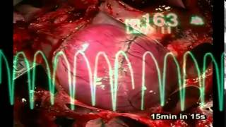 TV/FV [sin pulso]