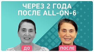 Об имплантации all-on-6® спустя 2 года ? из первых уст пациентки Smile-at-Once