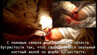 Реинсерция дистального сухожилия бицепса