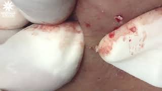 BLACKHEADS AND ACNE REMOVAL #33 | Nặn mụn ẩn dưới da, mụn đầu đen | 黑頭和粉刺去除 | 0934000075