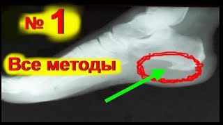 Пяточная шпора лечение в домашних условиях! Как лечить шпору- боль в пятке - № 1| edblack