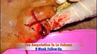 Floating Doctors:  Toe Amputation Follow-Up (Warning:  Graphic Surgical Content)
