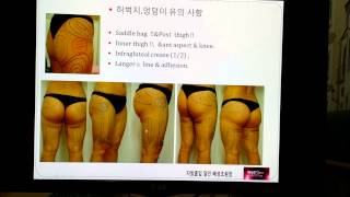 엉덩이 지방흡입 힙업-배성조원장 친절한 설명,