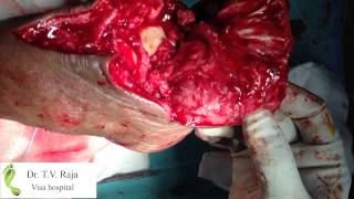 Dr  T V  Raja   Foot Amputation   Top Closure   Visa Hospital   Chennai