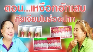Healthy Tips EP.3 เดือนกันยา ตอน เหงือกอักเสบ ภัยเงียบในช่องปาก