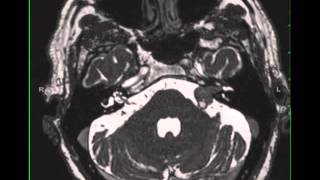 Vestibular Schwannoma, left