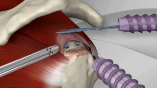 Chirurgie orthopédique épaule : réparation coiffe des rotateurs à Avignon (Vaucluse).