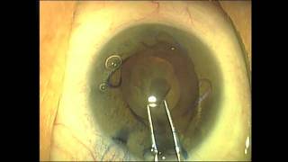 The Fladen Eye Center: Complex Cataract Surgery, Malyugin Ring & Multifocal IOL