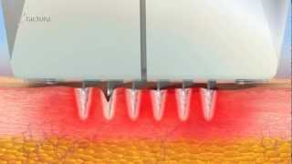 How Lasers Work : Collagen Stimulation and Production