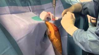 EASYNAIL TECHNIQUE OPERATOIRE. Docteur Le Guilloux