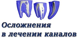 Осложнения при расширении, обработке и пломбировании корневых каналов. Эндодония. Стоматология