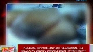 UB: Dalagita, inoperahan dahil sa abnormal na paglaki ng dibdib o Juvenile Breast Hypertrophy