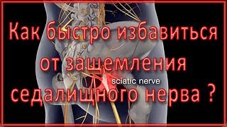 ▼Эффективное упражнение при защемлении седалищного нерва