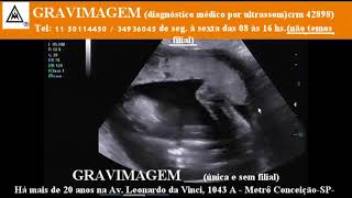 GRAVIMAGEM 21500 Ultrassom morfológico em gravidez 24 semanas mp1