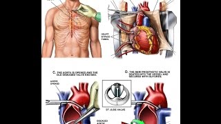 Heart valve surgery - operation for replacement heart valves