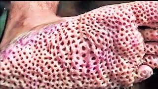 Trypophobia Feet and Jigger Removal - Yikes!