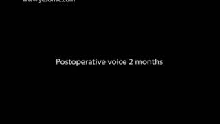 音声女性化手術前後の音声変化