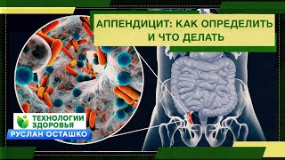 Аппендицит: как определить и что делать