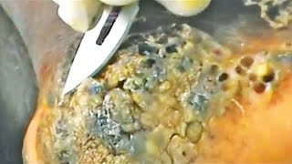 Intense Jigger Removal! Digging Jiggers, Before and After!