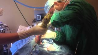 Jodi Amputation - Graphic Surgery