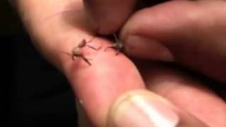 Medical Marvel: Army Surgery Ant and Stitches