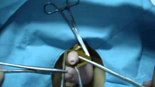 Circumcision - Clinical Skills Lab - Doctor Demonstration (in Indonesian language)