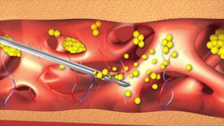 Липосакция и липофиллинг молочных желез на аппарате Body jet в ЦИДК