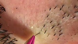 【Plucking facial hair】ずっと見ていられる豊潤のヒゲ抜き 2018.8.25（鼻下ヒゲ⓵編）