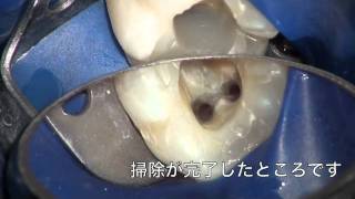 KINOSHTIA DENTAL OFFICE ~大きな膿の袋の治療