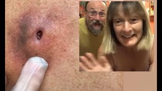 70+ Days Old Infected Cyst - Su Verhoeven's Cysts & Popping