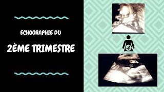 ECHOGRAPHIE DU 2ème TRIMESTRE