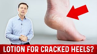 Why Lotion Never Fixes Dry Cracked Feet & Heels