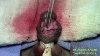 Mid penile Hypospadiac Cripple Devendra's Anatomical repair