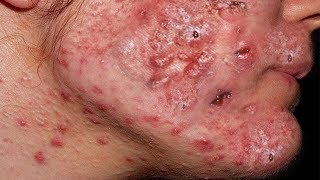 Новое выдавливание ПРЫЩЕЙ и ЧЕРНЫХ ТОЧЕК!  p15