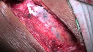 anterior approach to thoracic spine - Dr Sandeep Sonone