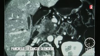 Santé - Pancréas : le cancer du silence