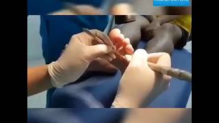 Điều trị mụn cóc bằng phương pháp đốt điện tại (#đốtmụncóc) - Stamford Skin Centre