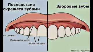 Если вы Скрипите Зубами по Ночам, Вот что Это Значит!