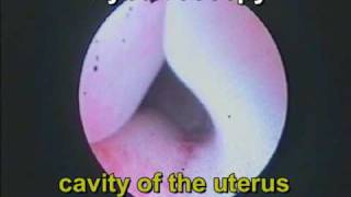 Uterus duplex and vagina duplex. Vaginoscopy. Hysteroscopy.