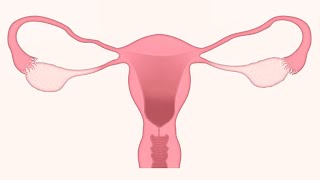Tratamiento para los miomas uterinos