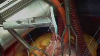 Mitral repair / Dr Vigneron ( clinique Tonkin)